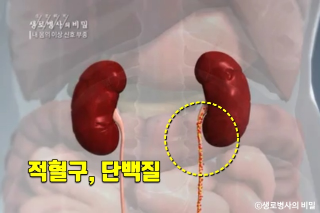 종아리 얼굴 붓는 이유, 붓기 부기 부종 원인 증상, 생로병사의 비밀, 다이어트 건강, 팁줌 매일꿀정보