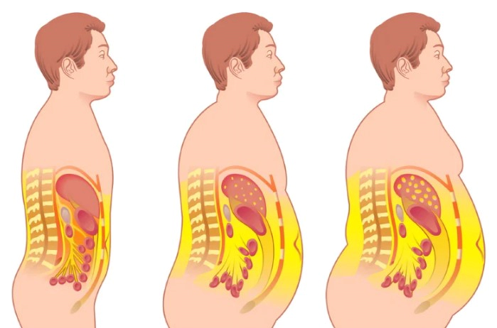 내장지방 빼는법 운동 음식 및 내장지방 레벨 수치 총정리