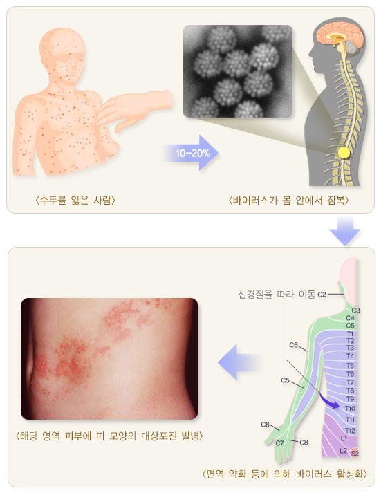 대상포진 빨리 낫는 법