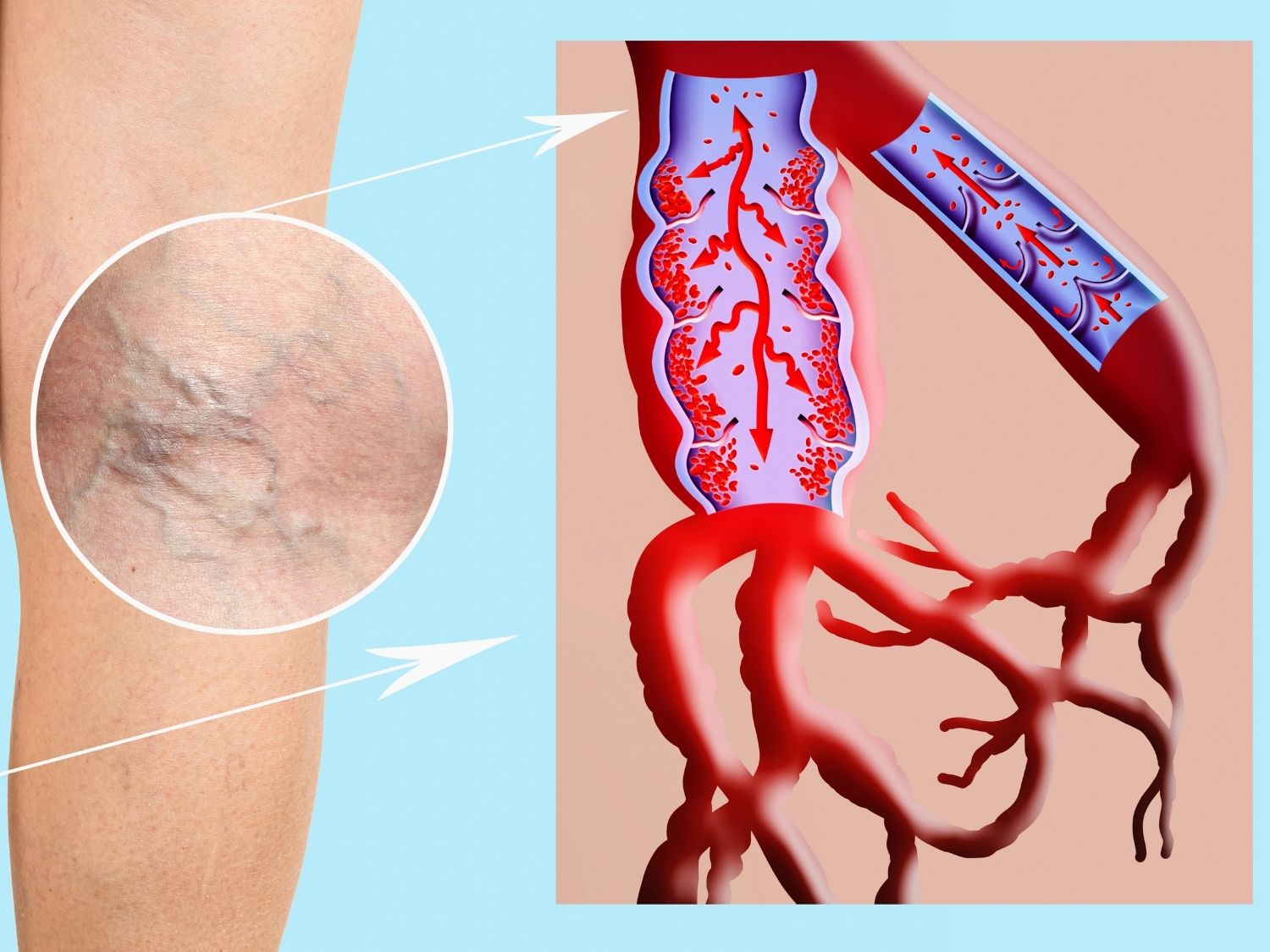 하지정맥류 증상