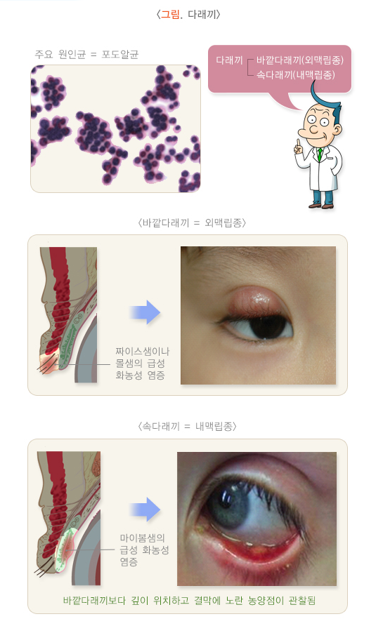 다래끼 관련 이미지