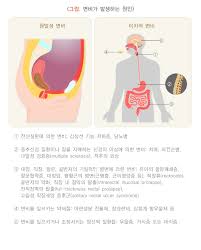 변비 탈출을 위한 종합 치료법