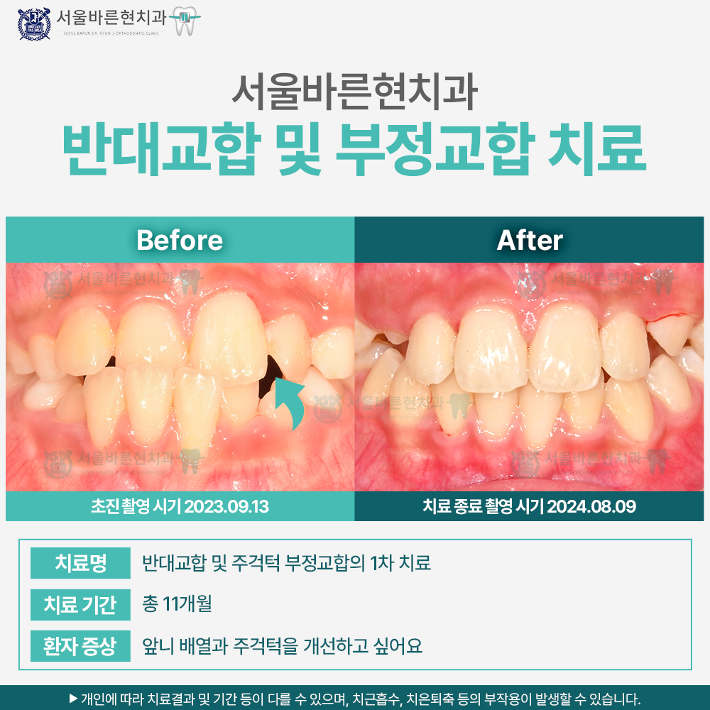 부산치아교정