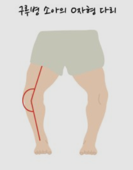 구루병 증상