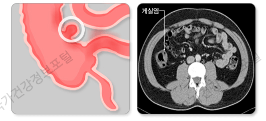 게실염