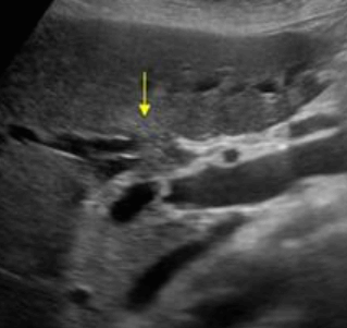 간문부 담관암(Klatskin's tumor = Hilar cholagiocarcinoma)