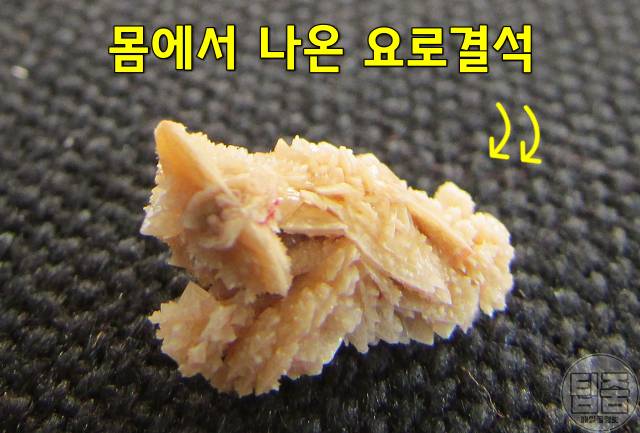 요로결석 녹이는 음식 요로결석 좋은 음식