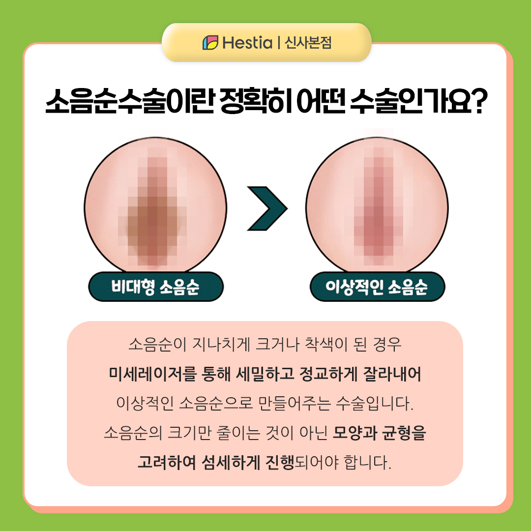 소음순수술, 어떤 수술인가요?