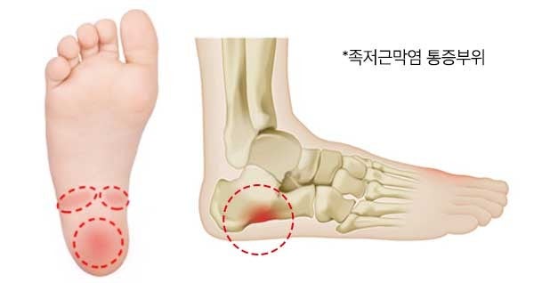 족저근막염, 운동 해도 될까? 통증 관리와 회복운동 가이드 관련 사진