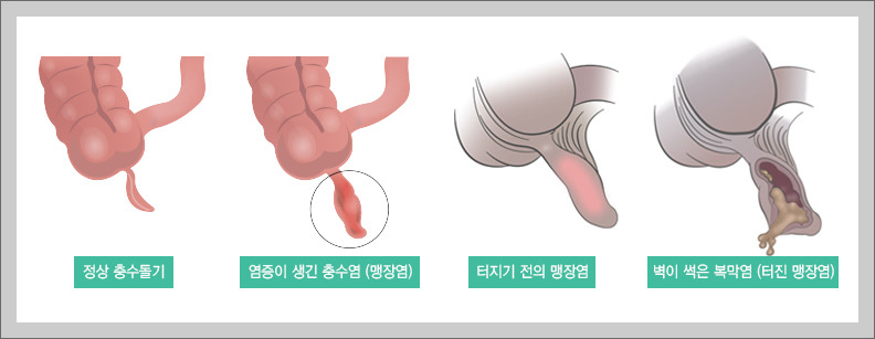 맹장염