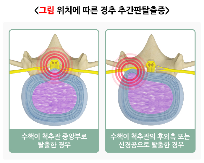 경추통증