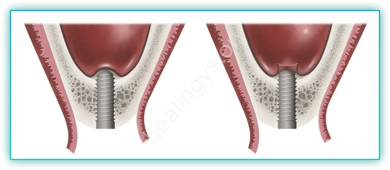상악동 거상술 부작용