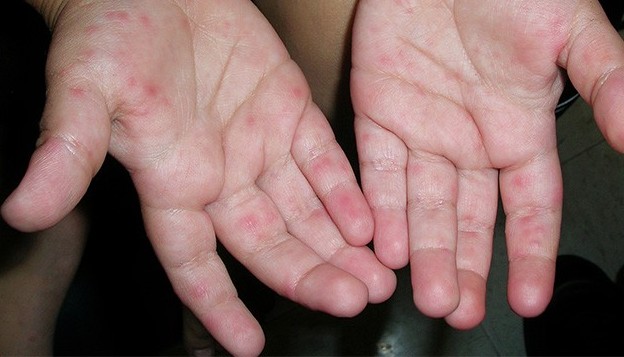 수족구 증상이 손바닥에 나타남