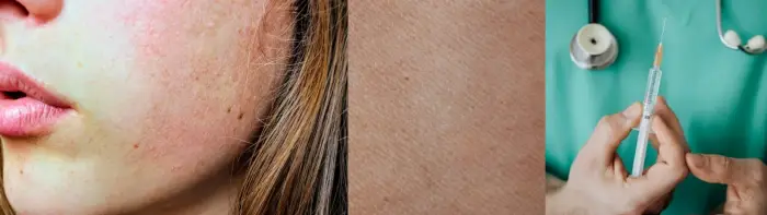 성인 홍역 증상