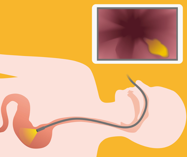 위 내시경을 받는 사진