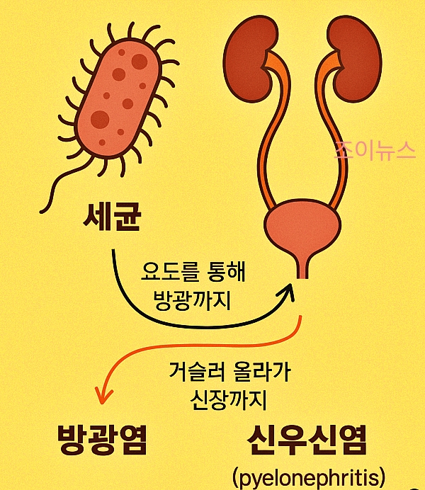 감염 경로가 다른 방광염과 신우신염