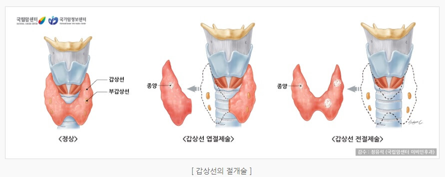 갑상선암의 절개술