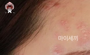 대상포진