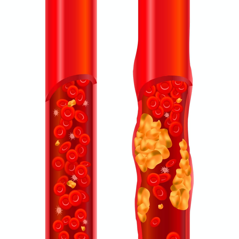 콜레스테롤이-있는-혈관과-콜레스테롤이-없는-혈관