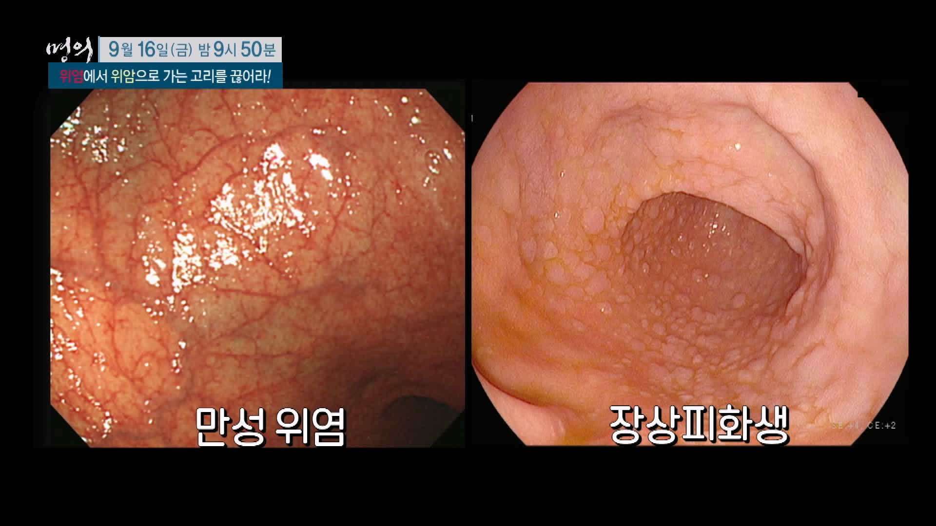 명의 소화불량, 만성 위염에서 위암으로 가는 고리 헬리코박터 균 치료 방법 삼성 서울 병원 김재준 교수 추천 소개