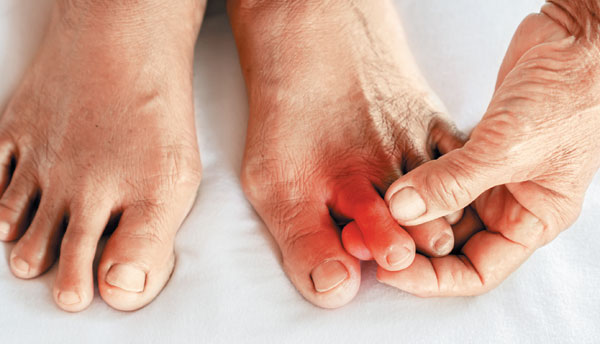 통풍 관련 사진