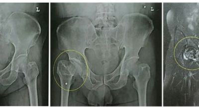고관절 이미지