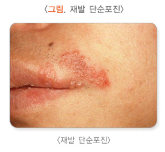 재발단순포진