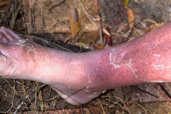 봉와직염(Cellulitis) – 원인, 증상, 치료법 정리