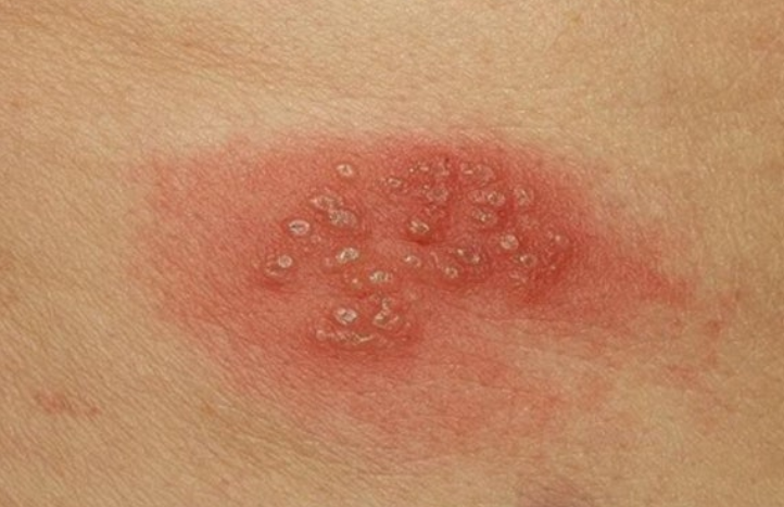 대상포진-초기증상-피부
