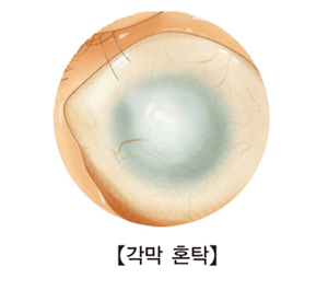 각막혼탁