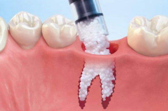 임플란트 시술과정 