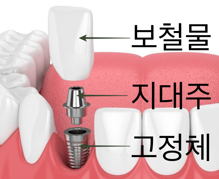 임플란트-구성품