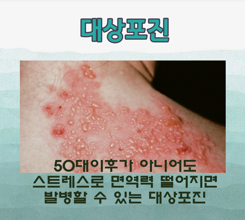 대상포진
