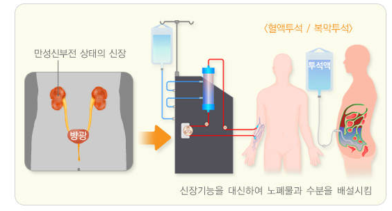 혈액투석, 복막투석