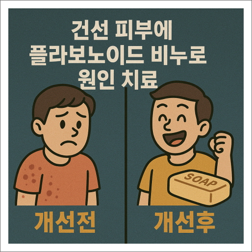 건선 피부에 플라보노이드 비누로 원인 치료