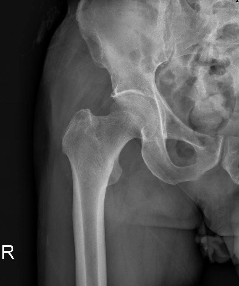 고관절 골괴사증