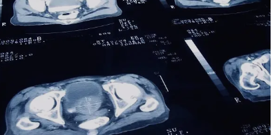 전립선비대증 원인&amp;#44; 증상&amp;#44; 치료법 총 정리 (2025 ver.)