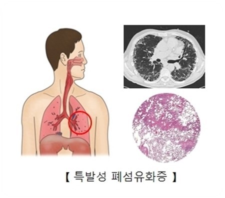 특발성 폐섬유증
