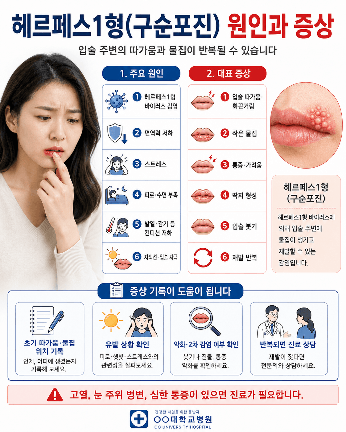 헤르페스 1형(구순포진) 원인과 증상