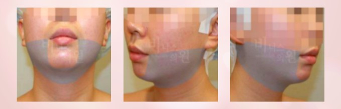 얼굴다이어트 볼살제거 얼굴살제거 브이라인지방이식 부천지방흡입 부천지방이식 얼굴지방흡입