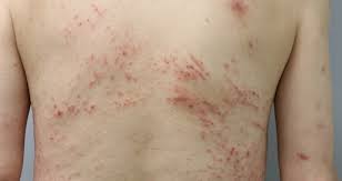 온몸이 가려운 증상