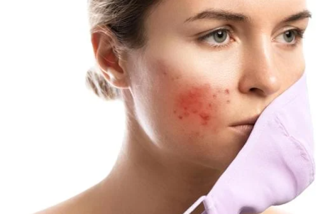 모낭염 원인과 치료방법