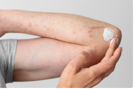 콜린성 두드러기 증상 치료