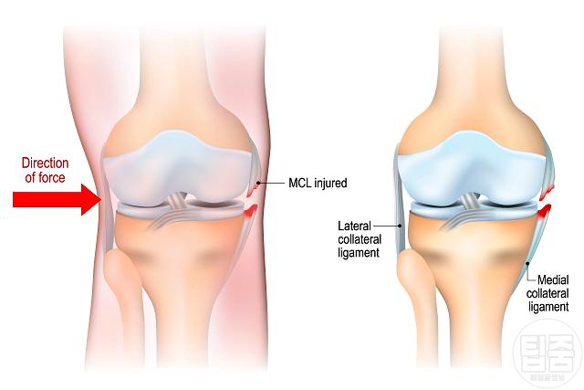 무릎 뒤 통증 원인 인대 부상