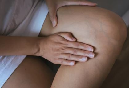 하지정맥류 원인