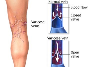 하지정맥류 베나실 치료법 및 장단점