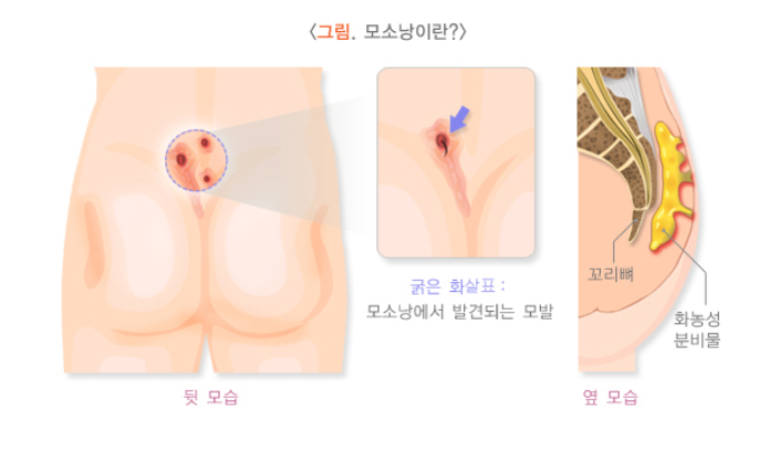 모소낭이란