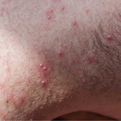 모낭염의 증상과 원인, 대처 방법