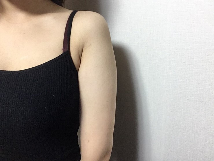 팔뚝지방흡입 후기