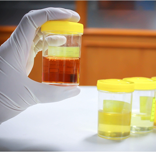 소변색깔이 노란색 원인